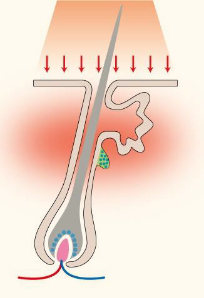 モテ肌脱毛styleの脱毛方式