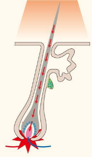 従来の脱毛方式